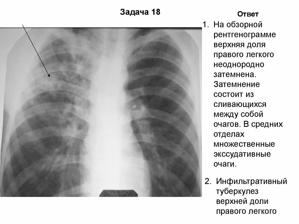 Инфильтративный туберкулез рентген. Инфильтративный туберкулез верхней доли рентген. Диссеминированный туберкулёз лёгких рентген. Инфильтративный туберкулез верхней доли правого легкого. Тени в верхней доле легкого