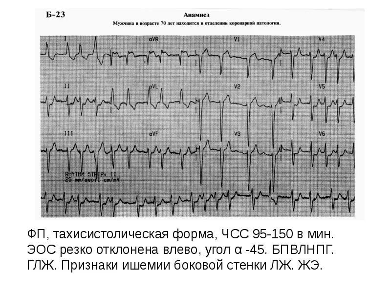 Мерцательная аритмия кардиосклероз. Мерцательная аритмия тахисистолическая форма экг. фибрилляция предсердий тахисистолическая форма экг. экг при фибрилляции предсердий тахисистолическая форма. трепетание предсердий тахисистолическая форма.