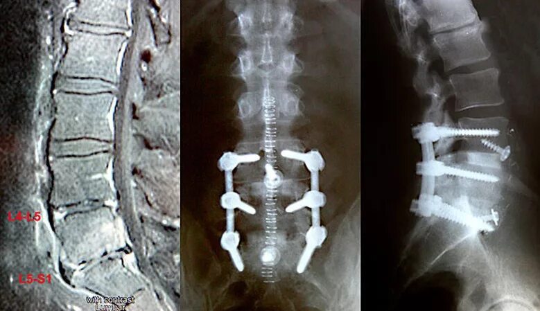L5 s1 диск остеохондроз. Задний спондилодез l5 l6. Имплант l2 l3 позвонка. Спондилолистез спондилодез Кейдж. Спондилодез l5 s1.