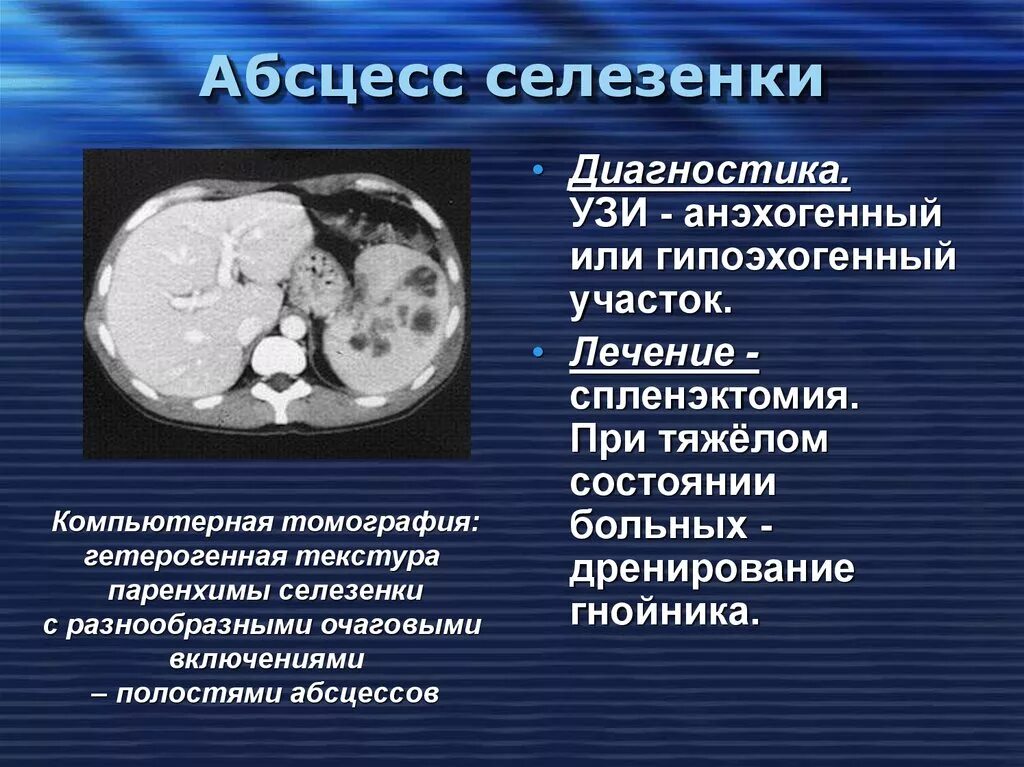 Очаговое образование селезенки. Абцесса селезенки.