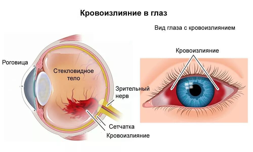 Глаза давление сильное. Кератит, конъюнктивит, увеит). Птеригиум конъюнктивы пингвекула. Кровоизлияние в стекловидное тело глаза. Кровоизлияние в роговицу глаза.