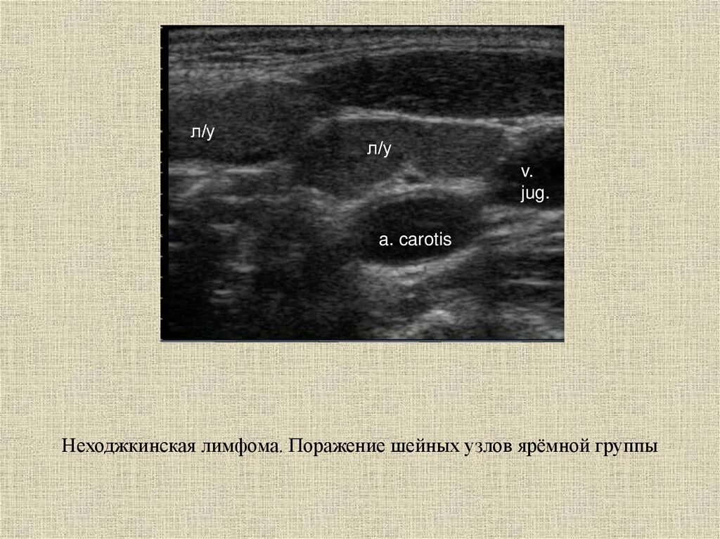 Лимфома лимфатические узлы. УЗИ лимфоузлов при лимфоме Ходжкина. Лимфогранулематоз УЗИ лимфоузлов. УЗИ лимфатических узлов норма. УЗИ лимфатических узлов при неходжкинской лимфоме.