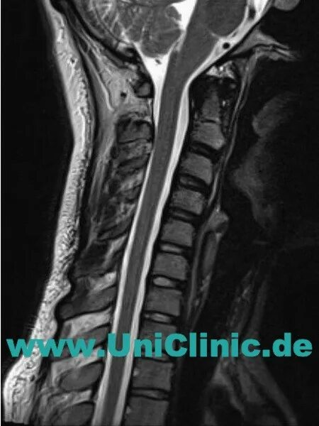 периневральная киста тарлова. экстрадуральная киста позвоночника мрт. арахноидальная киста позвоночника s2. аневризмальная костная киста позвоночника мрт. арахноидальная киста тарлова.