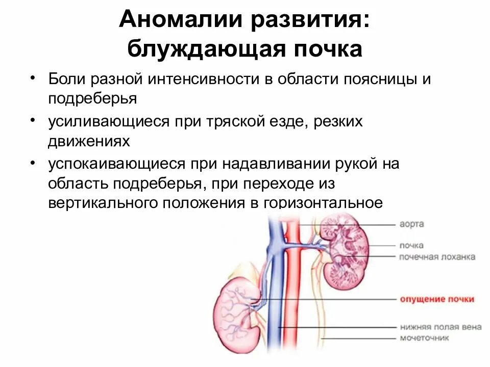 Лечение блуждающей боли. Аномалии развития почек.