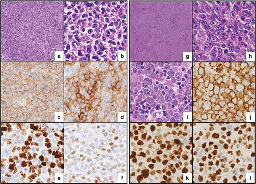 Лимфома Беркитта гистология. Крупноклеточная лимфома гистология. Анапластическая крупноклеточная лимфома гистология.