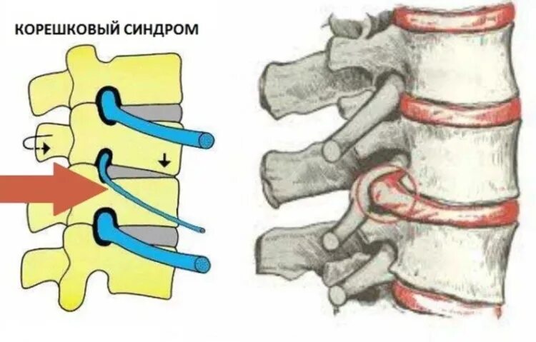 Корешковое поражение. Сдавление Корешков спинномозговых нервов. Корешковый синдром с1. Радикулопатия s1 Корешков. Корешковый синдром l5.