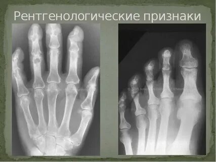 Рентгенологические признаки подагры