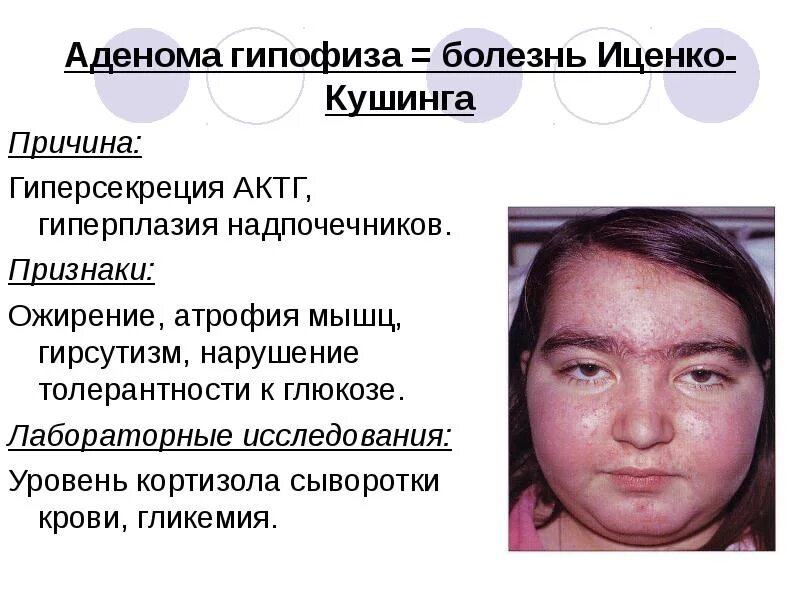 Синдром иценко кушинга причины. Гормоны при болезни иценко кушинга. аденома гипофиза иценко кушинга симптомы. гирсутизм при синдроме иценко кушинга. ожирение при синдроме иценко-кушинга у детей.