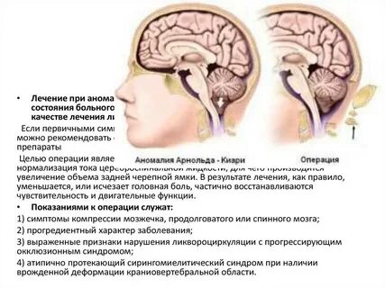 Что такое аномалия арнольда киари
