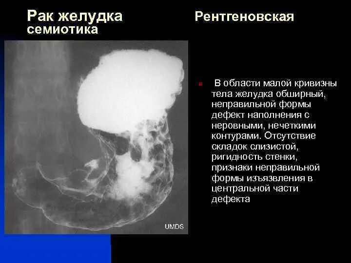 Как развивается рак желудка. Рентгенограмма 12 перстной кишки. опухоль желудка на рентгене признаки. злокачественная опухоль желудка рентген. экзофитная опухоль желудка рентген.