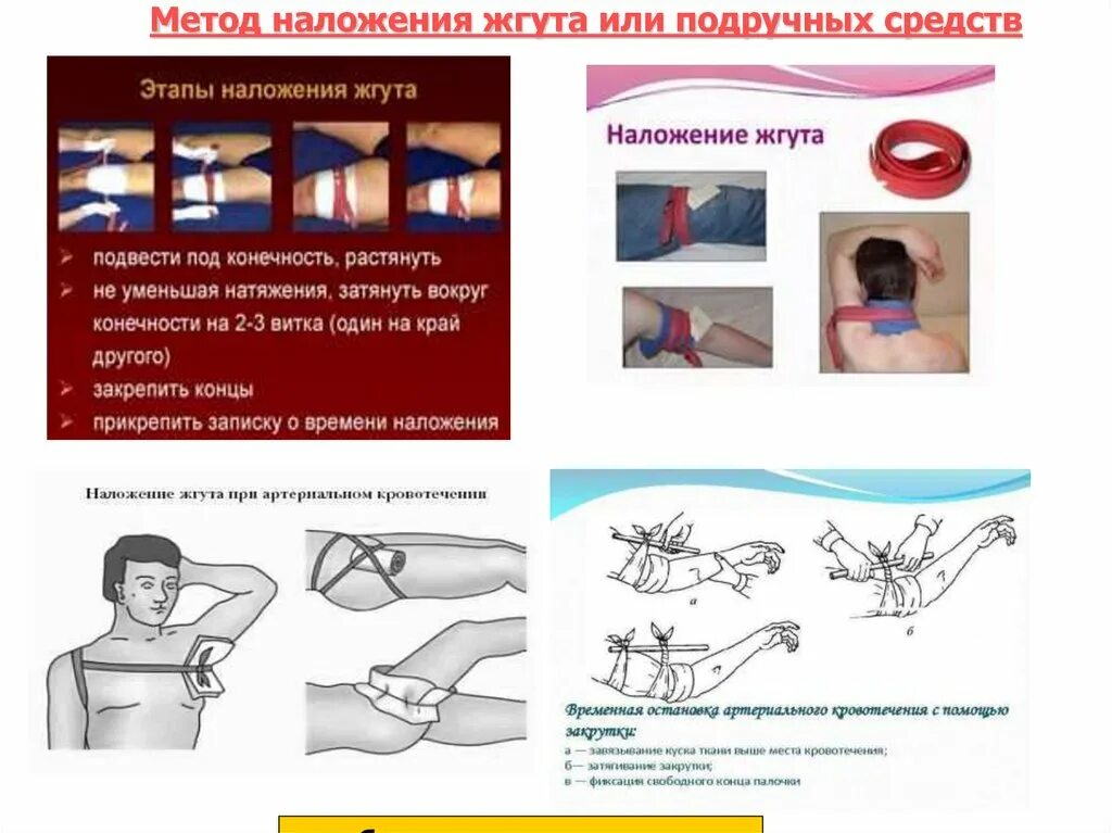 Техника наложения кровоостанавливающего артериального жгута