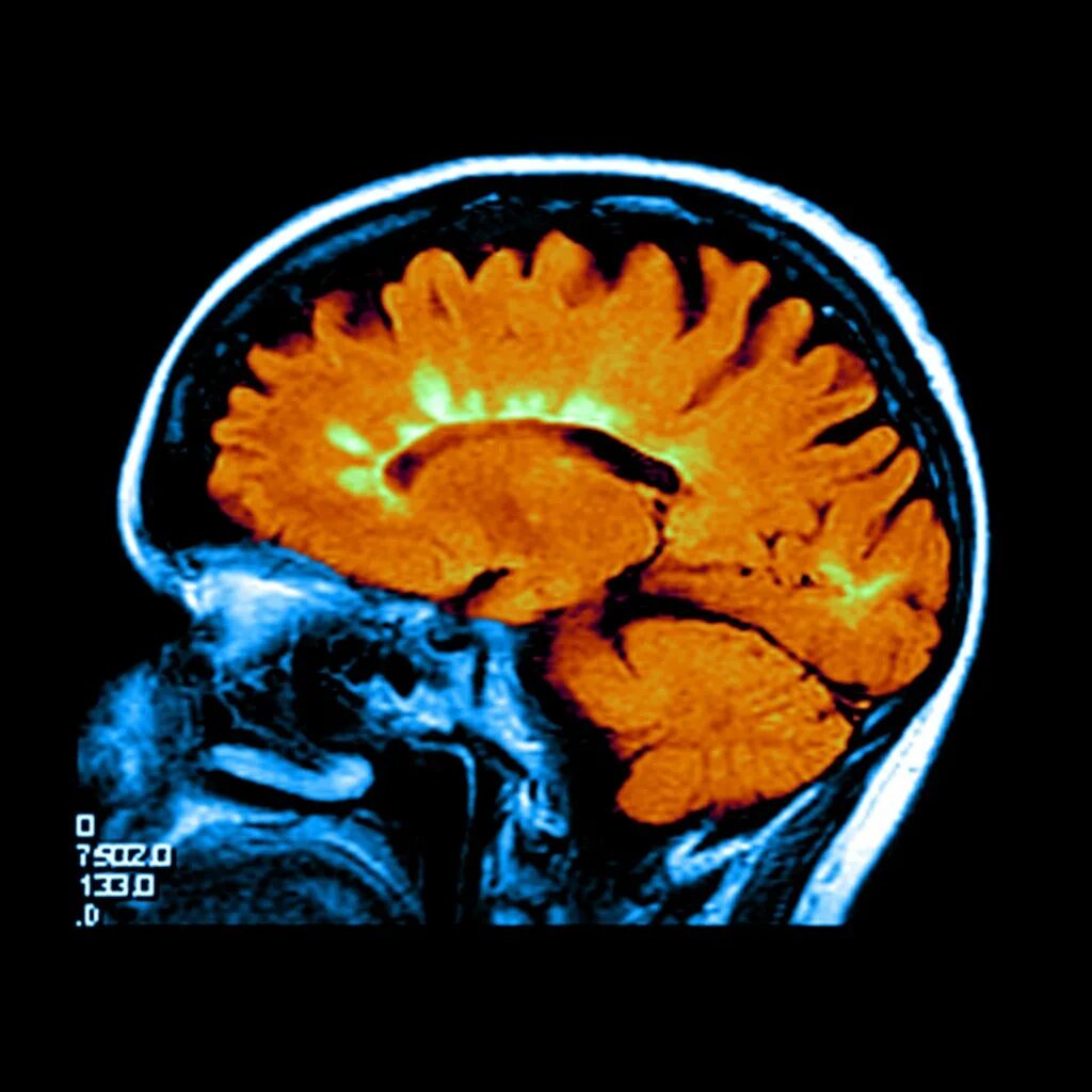 Склероз мозга. Рассеянный склероз мозга атрофия. Головной мозг при рассеянном склерозе. Атрофия головного мозга при рассеянном склерозе. Мозг человека с рассеянным склерозом.
