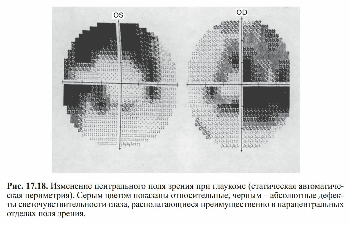 Периметрия глаза при глаукоме. Статическая компьютерная периметрия глаза расшифровка. Статическая периметрия при глаукоме. Расшифровка компьютерной периметрии полей зрения. Центральное поле зрения