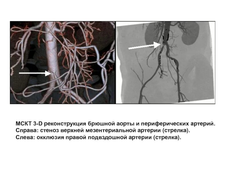 Сужение правой артерии. Атеросклероз бифуркации аорты. Окклюзия чревного ствола. Кальциноз брюшной аорты и подвздошных артерий. Кальциноз подвздошных артерий.