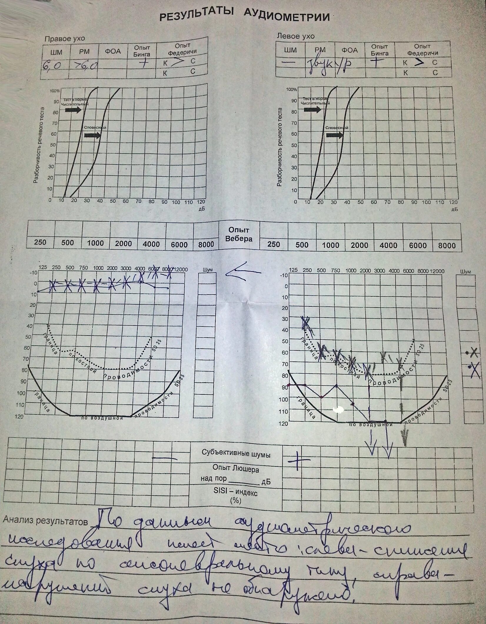 расшифровка аудиограммы слуха норма. аудиометрия результат. аудиометрия слуха норма таблица. аудиометрия результат. возрастная норма слуха на аудиограмме.