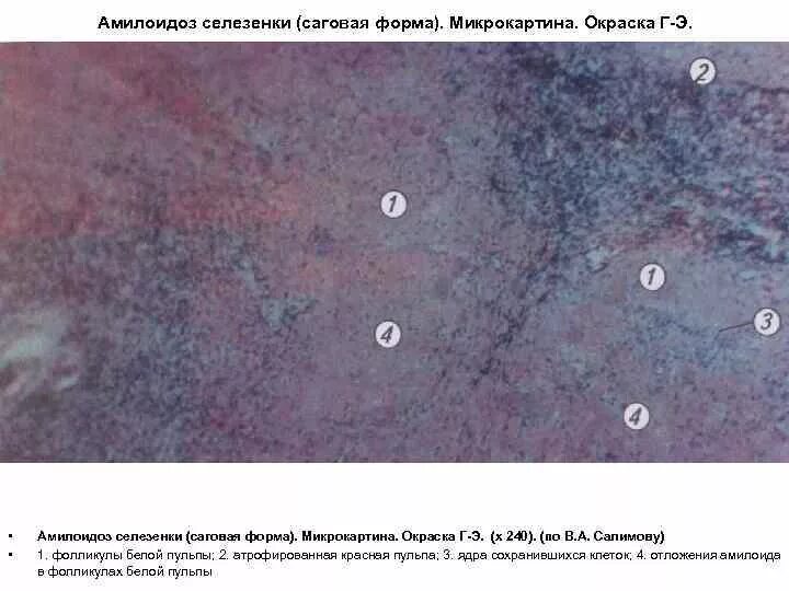 Саговый амилоидоз селезенки. Амилоидная дистрофия селезенки. амилоидоз селезёнки (саговая форма). амилоидоз селезенки – саговая селезенка. амилоидоз селезенки саговая селезенка микропрепарат.
