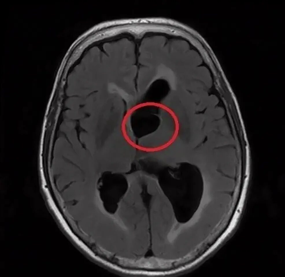 Дилатация бокового желудочка мозга. Арахноидальная киста головного мозга мрт. Арахноидальная киста бокового желудочка головного мозга кт. Арахноидальная киста бокового желудочка мрт. Арахноидальная киста головного мозга кт.