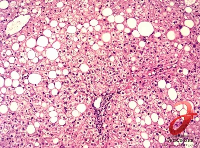 Жировой гепатоз печени гистология. Стеатоз 3. Жировая инфильтрация печени судан 3. Стеатоз печени макропрепарат. Стеатоз цирроз гистология.