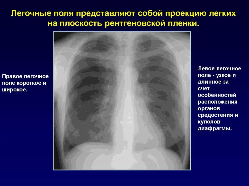 нижнее легочное поле. нижнее легочное поле. нижнее легочное поле. нижнее легочное поле. топографические зоны легочного поля.