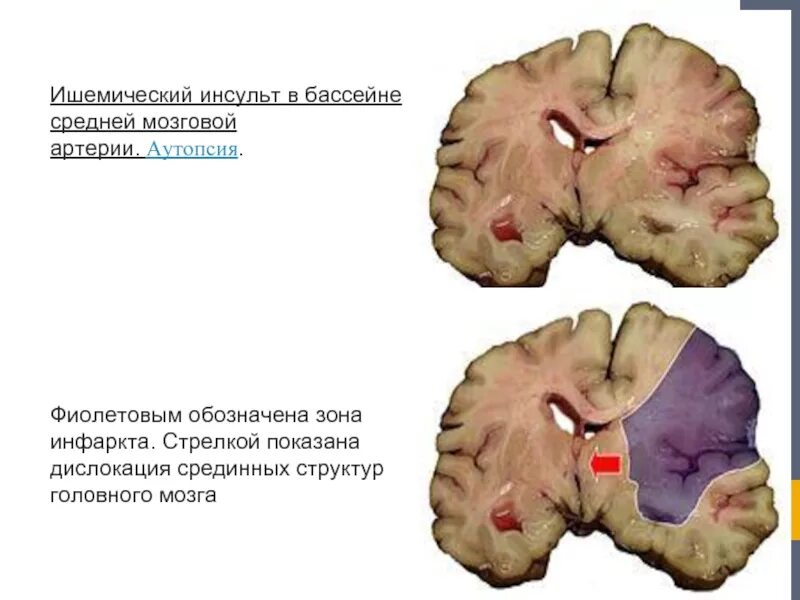 Размягчение головного мозга. Инсульт в бассейне левой средней мозговой артерии. Инфаркт в бассейне средней мозговой артерии. Инфаркт головного мозга в бассейне правой средней мозговой артерии. Ишемический инсульт в бассейне правой средней мозговой артерии.