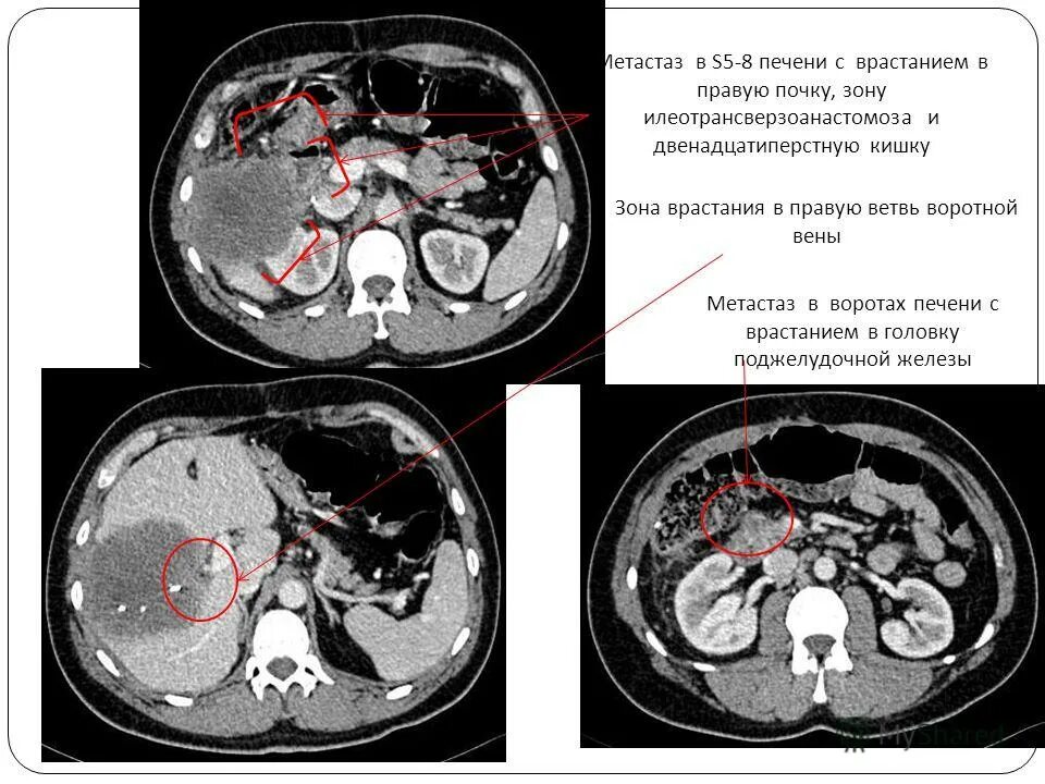 Гиперваскулярные метастазы печени кт. Множественные метастазы в костях. Метастазы в печени и в костях. Рак почки метастазы печени. Рак почки метастазы печени.