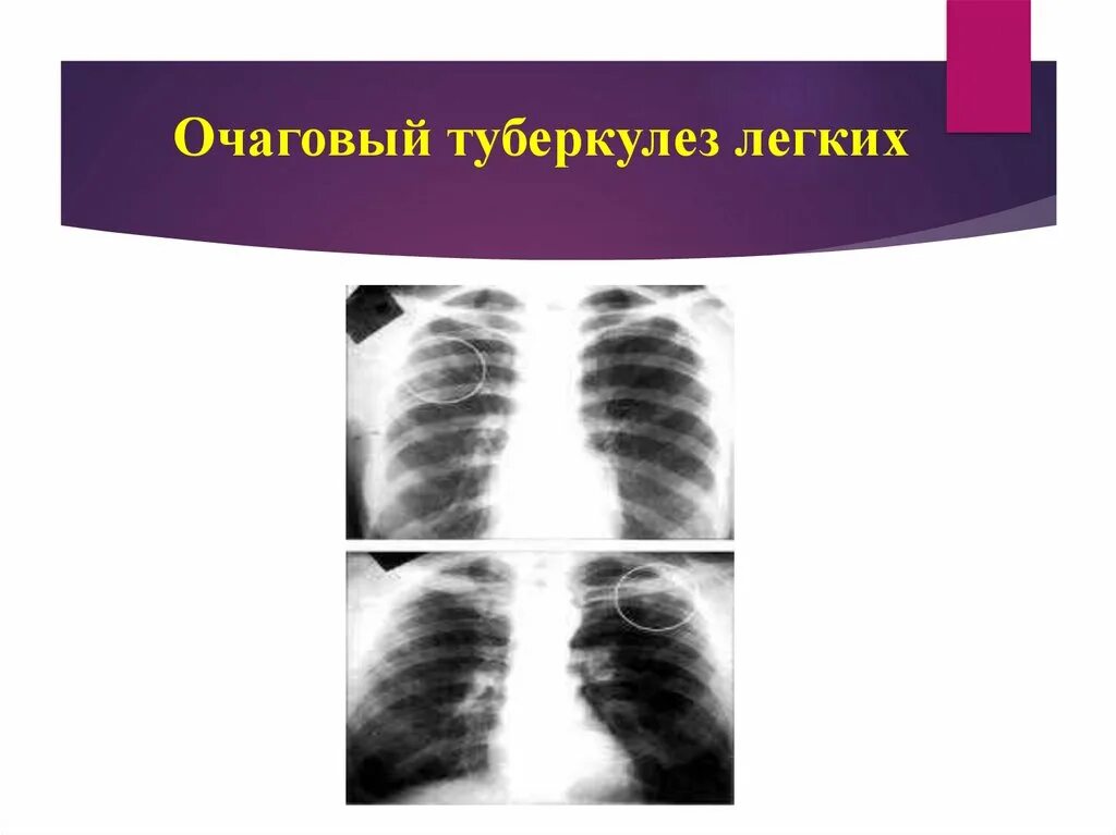 Очаговый туберкулез схема. Клинические формы вторичного туберкулеза. Очаговый туберкулез легких. Хронический очаговый туберкулез. Фазы очагового туберкулеза