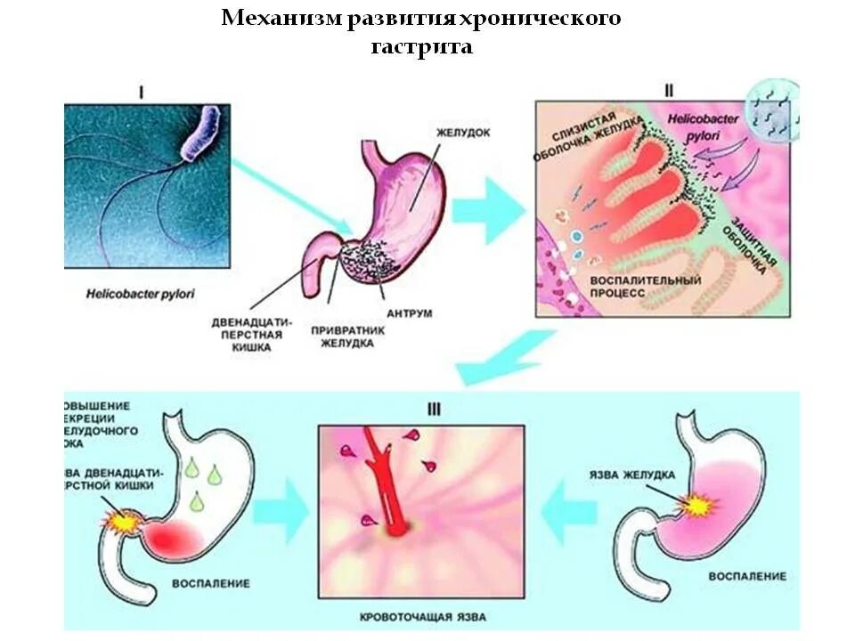 Патогенез язвенной болезни желудка хеликобактер пилори. Язвенная болезнь желудка и 12-перстной кишки патогенез. Хронический гастрит патогенез схема. Патогенетическая терапия хронического гастрита.