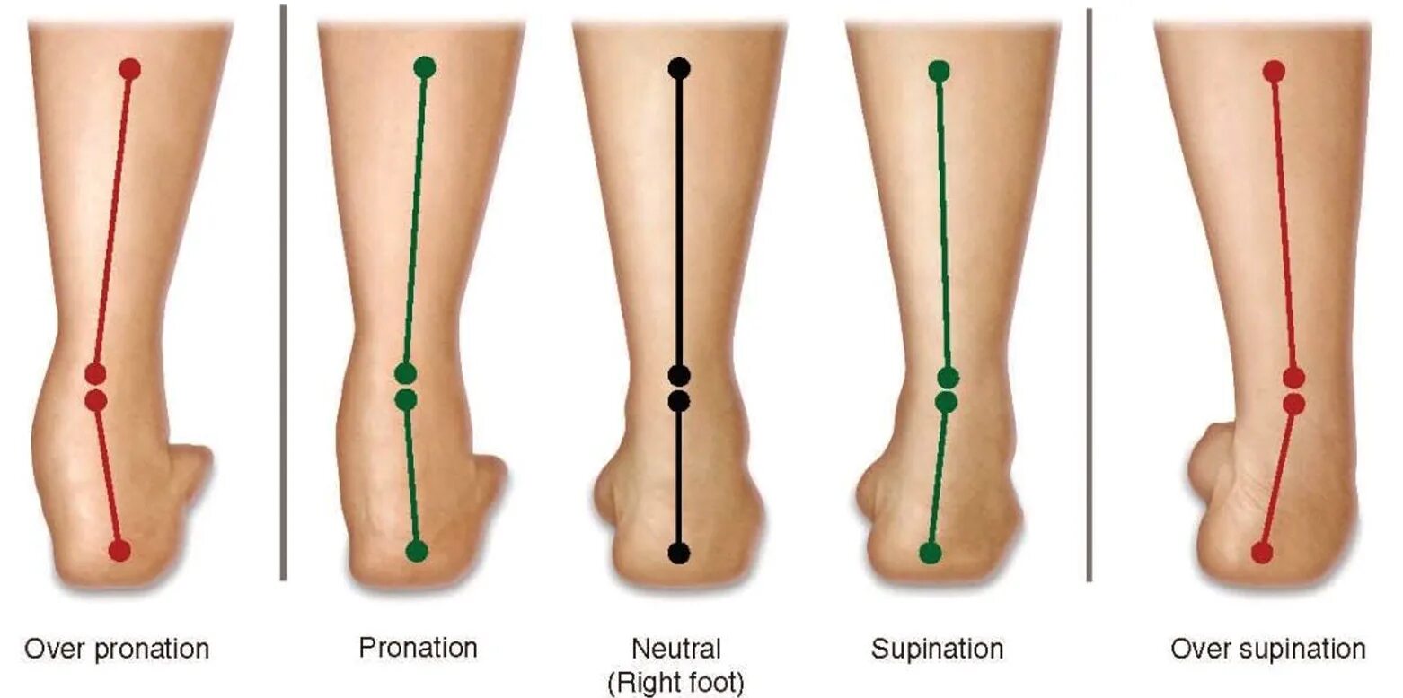 Пронация стопы гиперпронация. Пронация вальгус стопы. Супинация и пронация ноги. Пронация бедра. Значение правой ноги