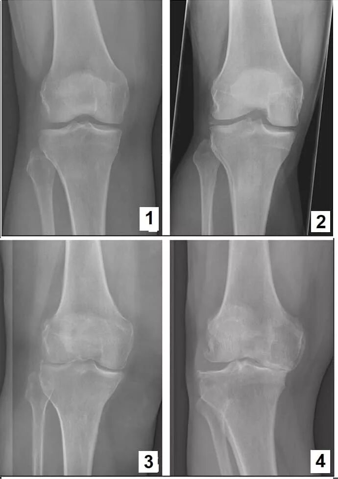 Артрит и артроз разница. Ревматоидный артрит рентген колени. Ревматоидный артрит коленного сустава рентген картина. Артрит коленного сустава рентгенограмма. Артрозо-артрит коленного сустава рентген.