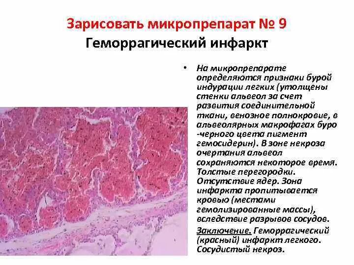 Геморрагический инфаркт легкого микропрепарат. Красный инфаркт легкого макропрепарат. Геморрагический инфаркт легкого патанатомия. Геморрагический инфаркт легкого микропрепарат. Геморрагический инфаркт легкого микропрепарат.