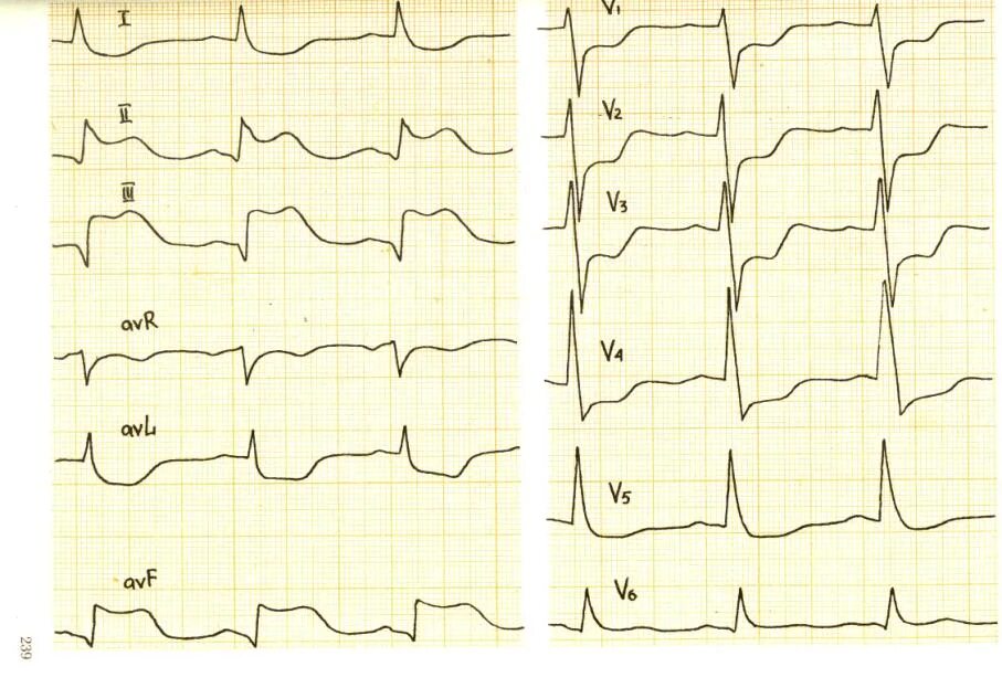 Ишемия боковой стенки. Инфаркт миокарда v1-v3 ЭКГ. ЭКГ при ишемии и инфаркта миокарда. Инфаркт в 3 отведении на ЭКГ. Инфаркт миокарда с зубцом q на ЭКГ.