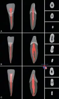 Анатомия корневых каналов резца нижней челюсти и советы по препарированию полост