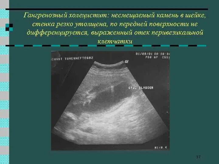 Изменение стенок желчного пузыря. Холестероз желчного пузыря эхограммы. УЗИ желчного пузыря холецистит. Перивезикальный инфильтрат желчного. Утолщение стенки желчного пузыря на УЗИ.