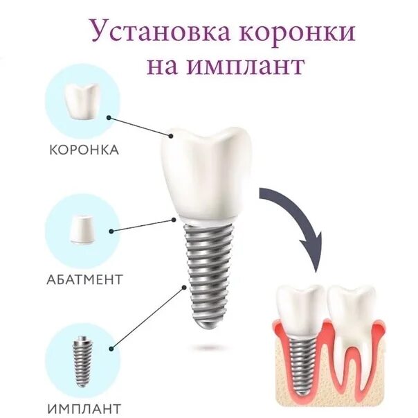 Какую функцию выполняет коронка. Имплантат абатмент коронка формирователь. схема имплант абатмент коронка. схема крепления коронки на импланты.
