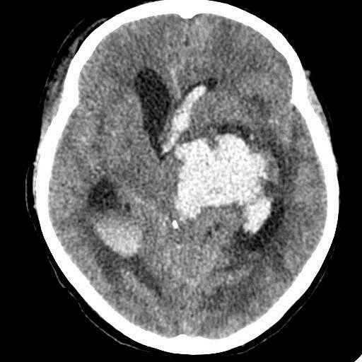 Кт головного мозга кровоизлияние. Кровоизлияние в 4 желудочек. Кровоизлияние в желудочки мозга кт. Кровь в желудочках головного мозга кт.