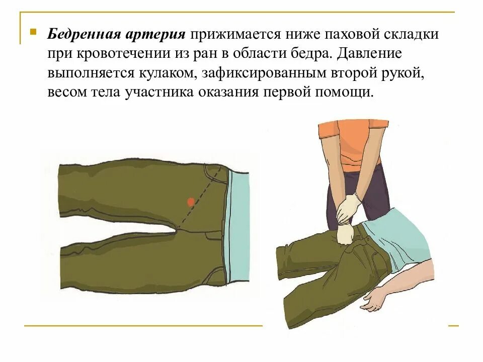 Пострадавшему с сильным наружным кровотечением. Бедренная артерия прижимается ниже паховой складки. Остановка кровотечения из бедренной артерии первая помощь. Оказание первой помощи при ранении бедренной артерии. Остановить кровотечение из бедренной артерии.