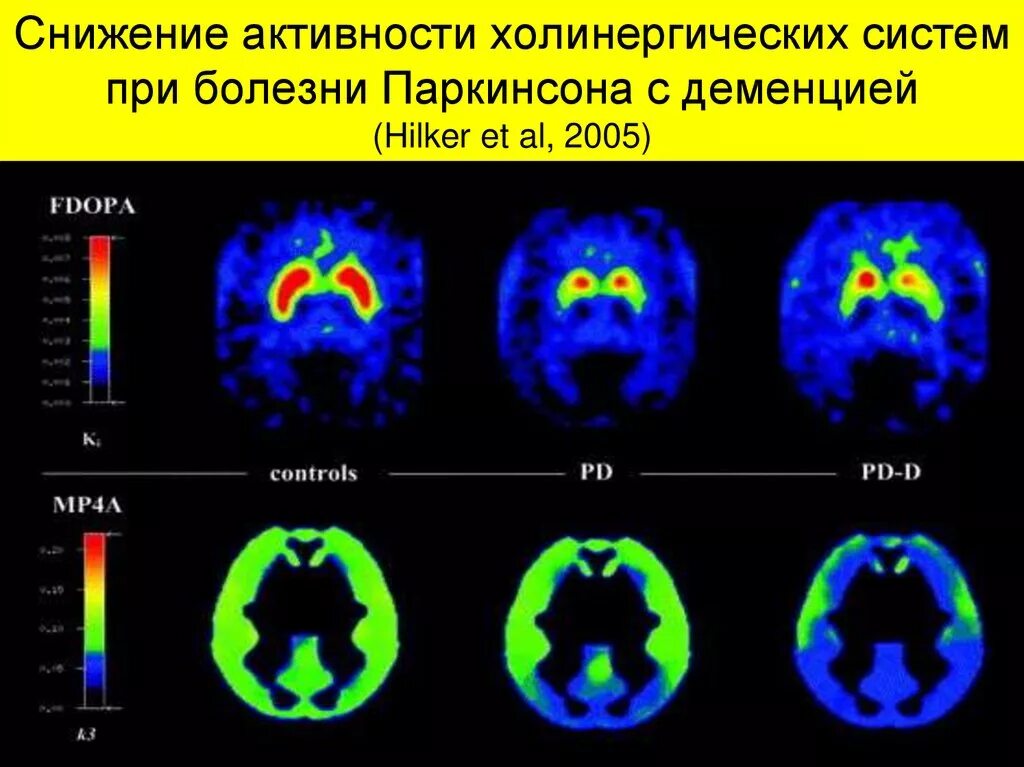 Деменция при паркинсоне. Мрт мозга при болезни Паркинсона. Кт при болезни Паркинсона. Мрт при паркинсонизме. Мрт при болезни Паркинсона.