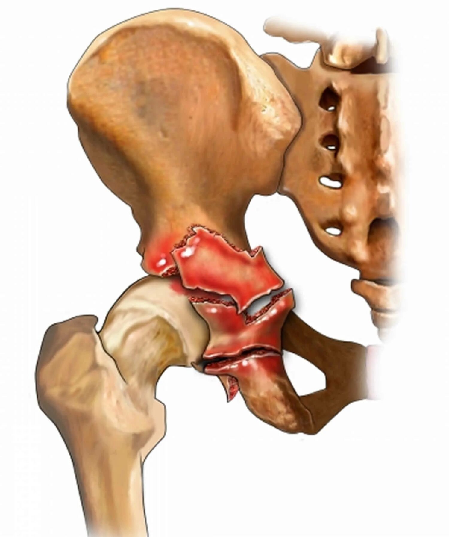 Повреждение тазобедренной кости. Перелом бедренной кости рентген. Повреждение тазобедренной кости. Лонная кость таза перелом анатомия. Субтотальный перелом шейки бедра.