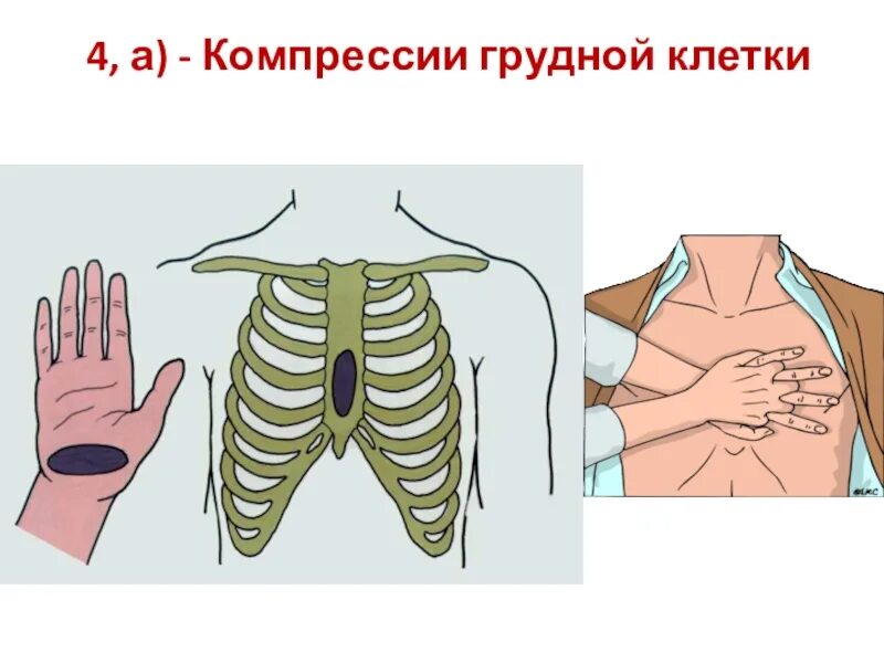 Компрессия грудной клетки. Сдавление грудной клетки. Точка проведения компрессии грудной клетки. Сжатие груди