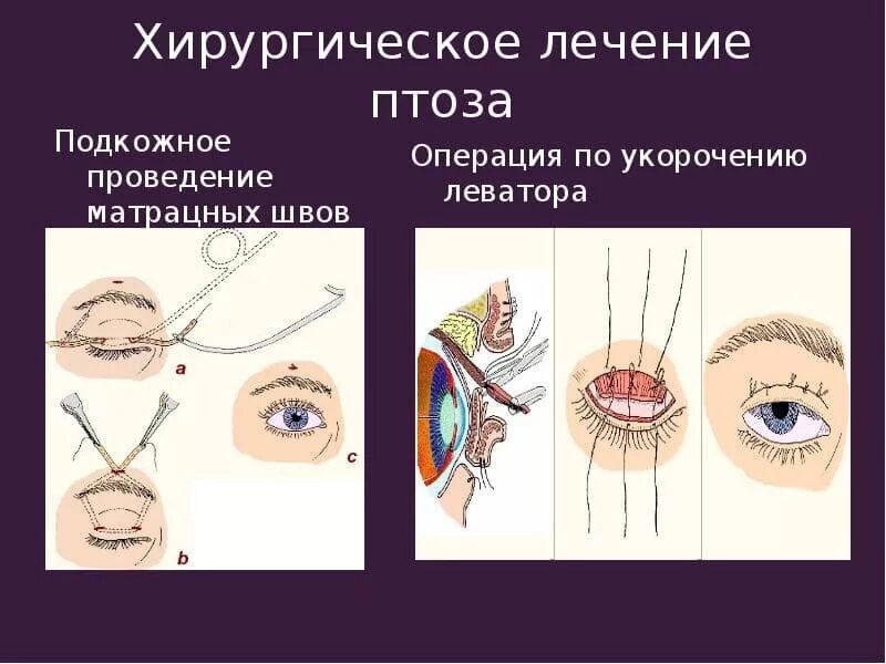 Птоз без операции. Операция при птозе верхнего века. Резекция леватора верхнего века. Резекция леватора верхнего века при птозе. Хирургическое лечение птоза.