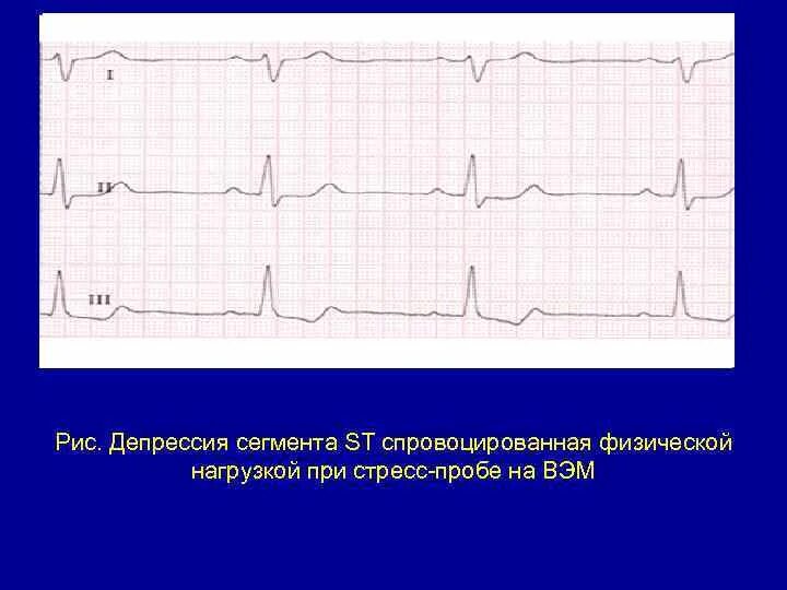 Эпизод депрессии st. Депрессия St в отведениях v6. Снижение сегмента St на ЭКГ. Депрессия сегмента St на ЭКГ v5 v6. Депрессия St v4-v6 ЭКГ.