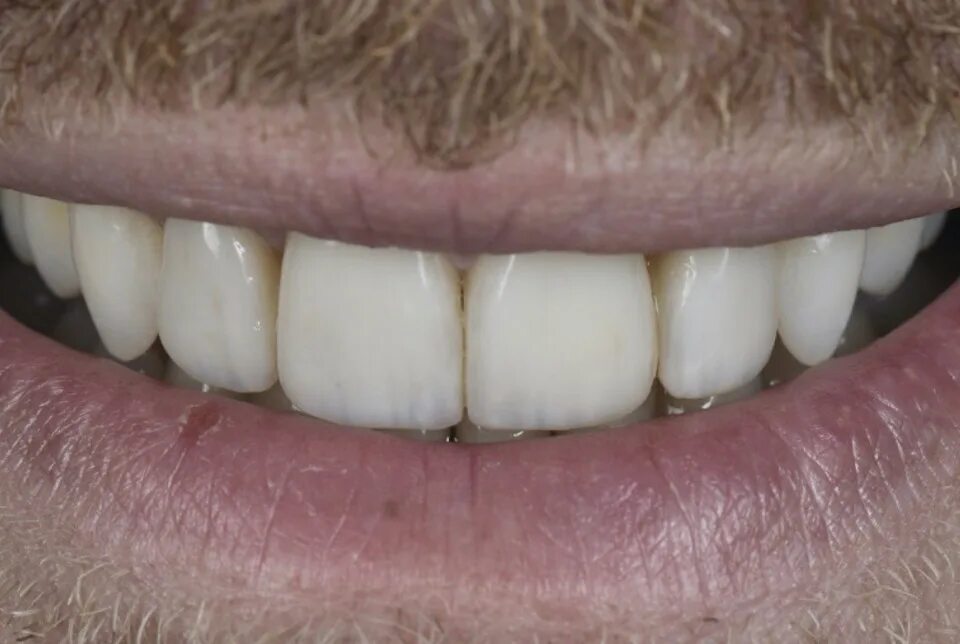 Винир прямой композитный