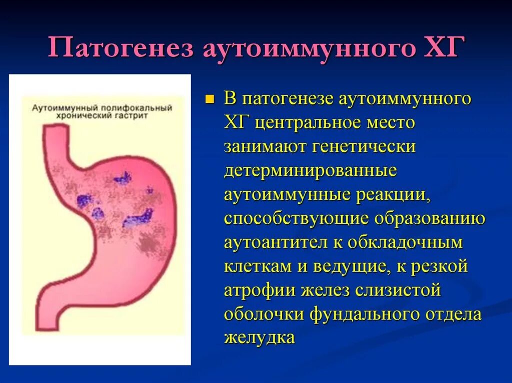 Хронический аутоиммунный гастрит патогенез. Патогенез аутоиммунный аутоиммунного гастрита. Аутоиммунный гастрит этиология. Аутоиммунный атрофический гастрит. Гастрит локализация