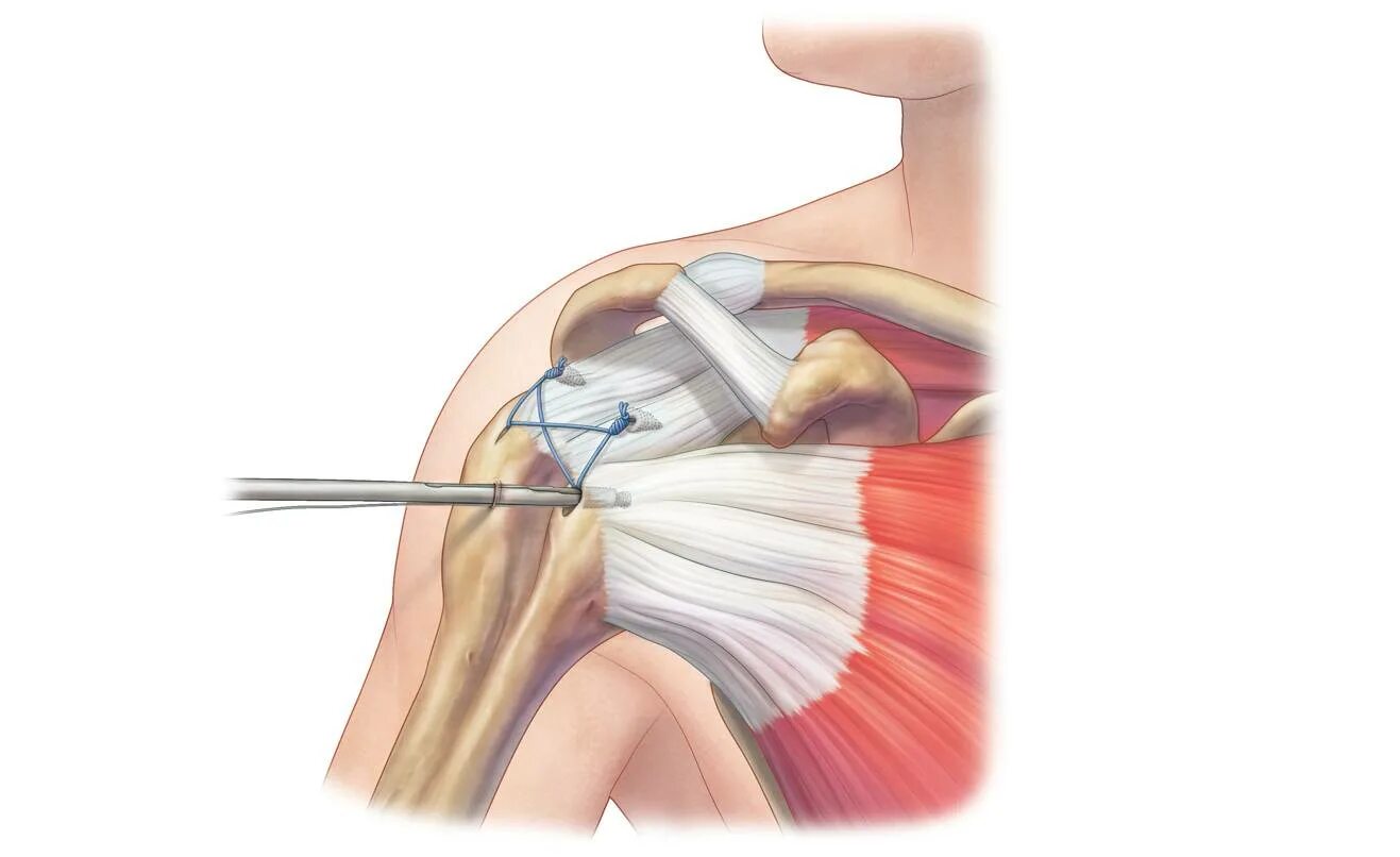 Тендинит ротаторной манжеты плечевого сустава. Кальцифицирующий тендинит плеча. Сшивание сухожилий плечевого сустава. Шов вращающей манжеты плеча плечевого сустава. Разрыв плечевого сустава симптомы