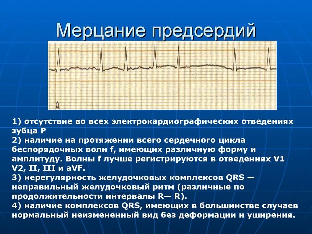 Мерцание фибрилляция предсердий на ЭКГ. Мерцание предсердий на ЭКГ признаки. Признаки мерцательной аритмии на ЭКГ. ЭКГ при мерцании и трепетании предсердий. Экг со скольки