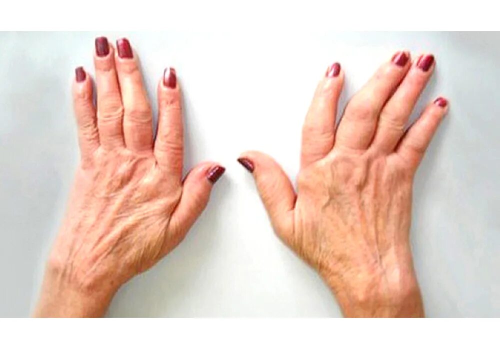 Деформирующий полиартрит суставов. Полиартроз суставов ног. Ревматизм и ревматоидный артрит. Псориазный ревматоидный артрит. Полиартроз суставов кистей.