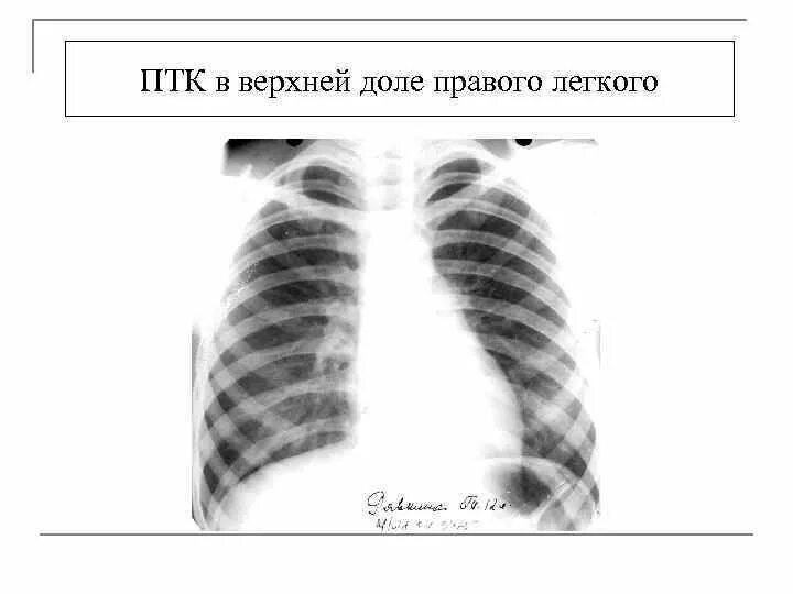 Очаг в верхней доле правого легкого. ПТК на рентгенограмме. Первичный туберкулезный комплекс рентген. Первичный туберкулезный комплекс на рентгенограмме.