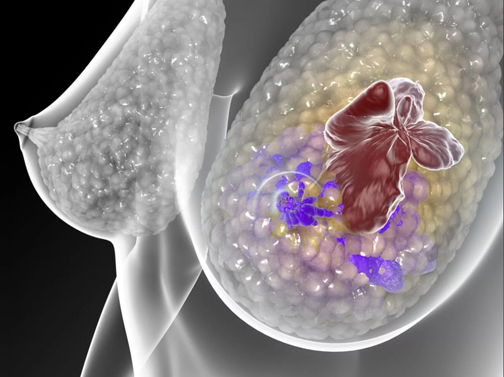 Опухоль молочной железы. Онкология грудной железы. Злокачественная опухоль молочной железы. Онкозаболевания молочной железы. Доброкачественная железистая опухоль