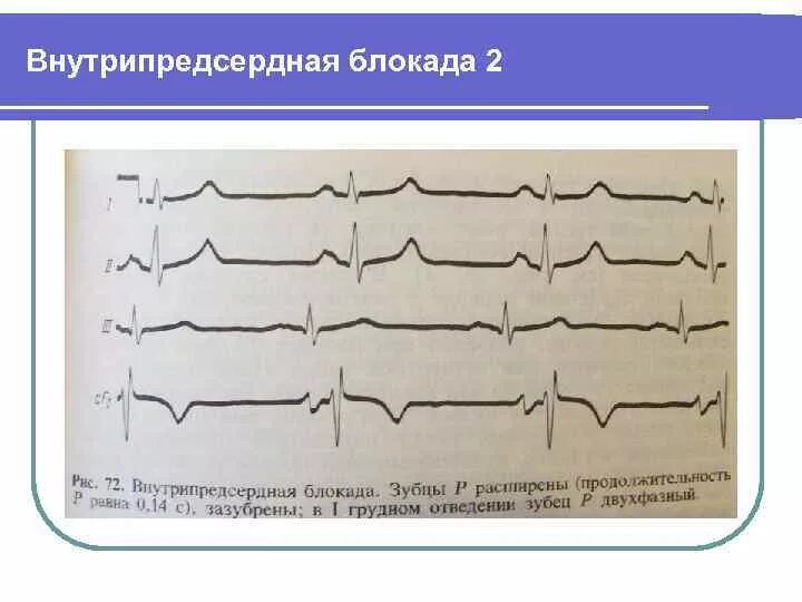 Предсердная блокада. Внутрипредсердная блокада 1 степени на ЭКГ что это такое. ЭКГ внутрипредсердная блокада av блокада 2 степени. Полная межпредсердная блокада на ЭКГ. Межпредсердные блокады на ЭКГ.