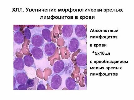 Лимфоциты в костном мозге